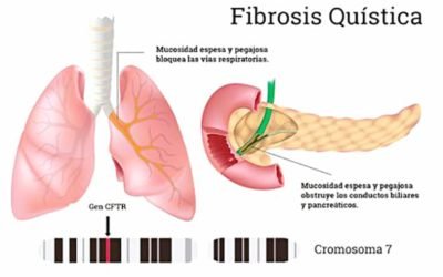 Fibrosis quística