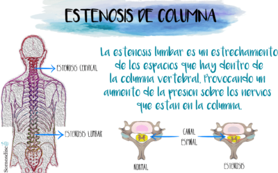 Estenosis del conducto vertebral