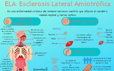 Infografía de la Esclerosis Lateral Amiotrofica