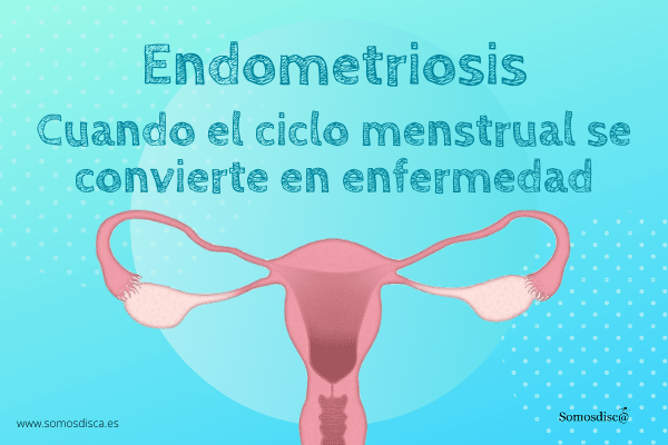 Endometriosis, cuando el ciclo menstrual se convierte en enfermedad