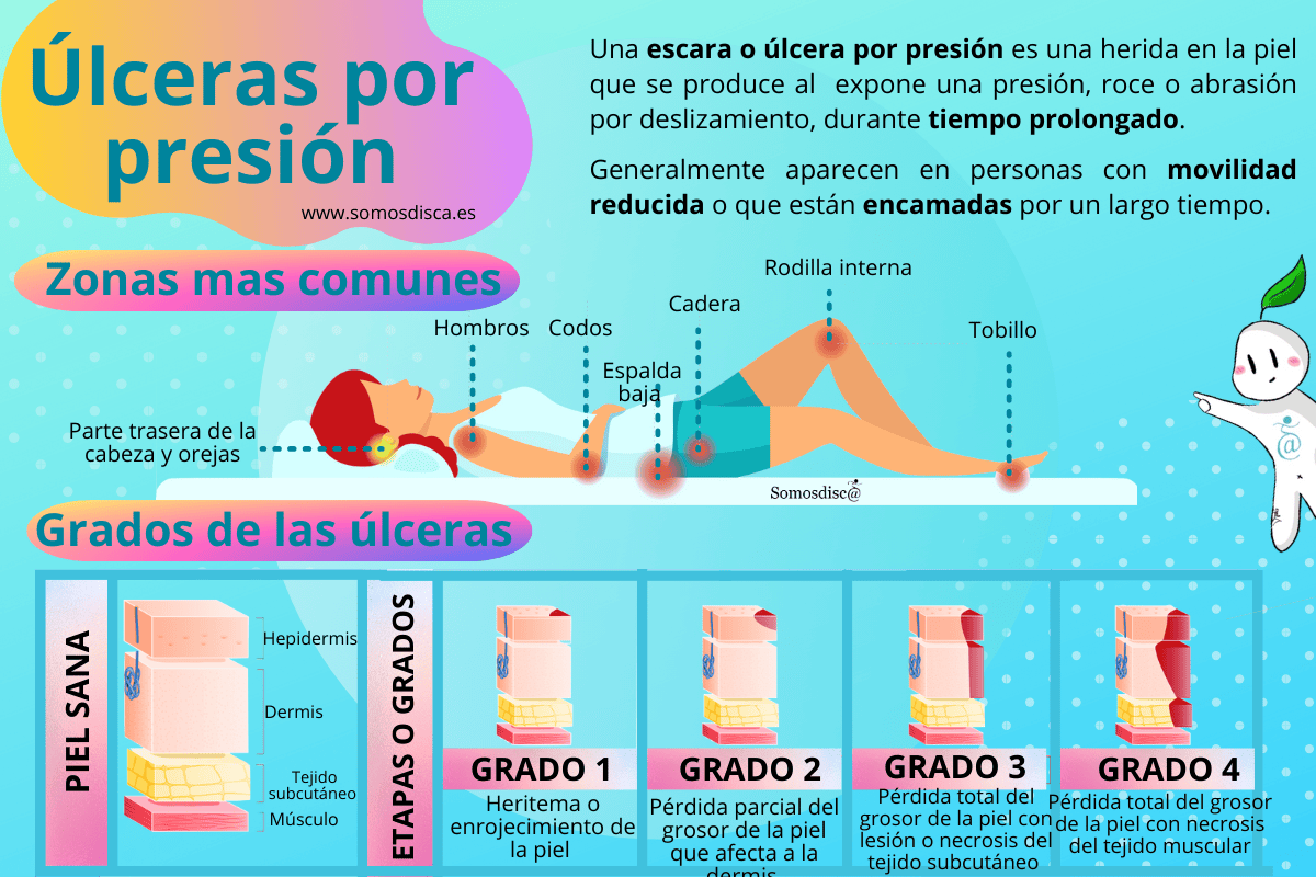 infografía Úlceras por presión