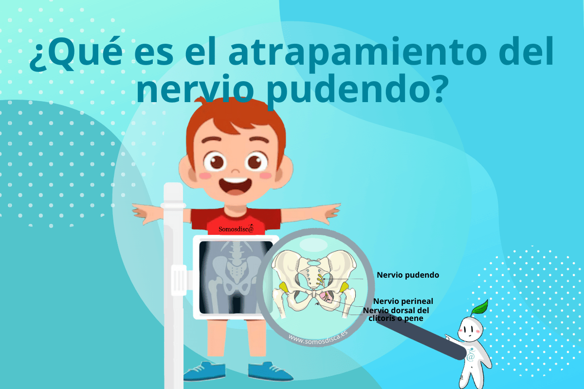 Qué es el atrapamiento del nervio pudendo? - Somosdisc@