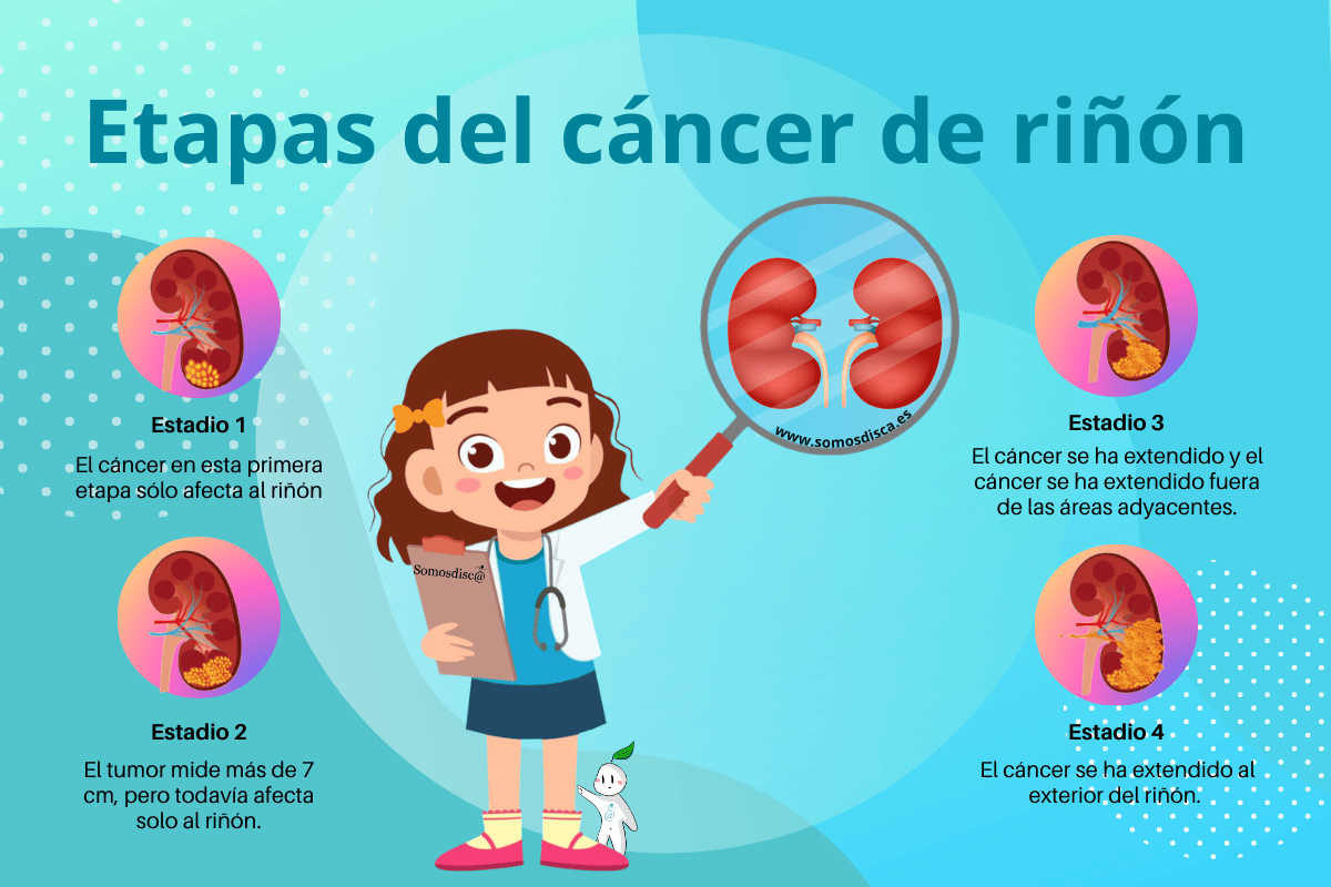 Etapas del cáncer de riñón