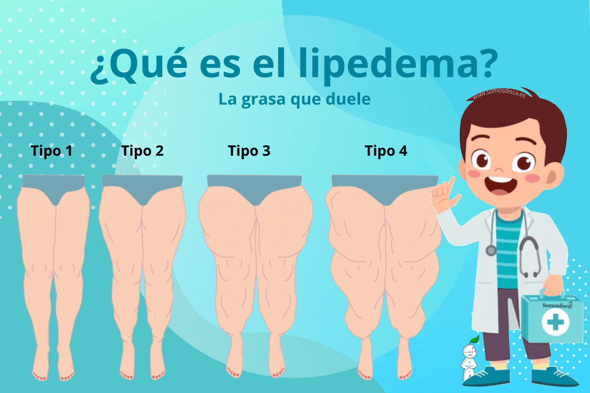 ¿Que es el lipedema